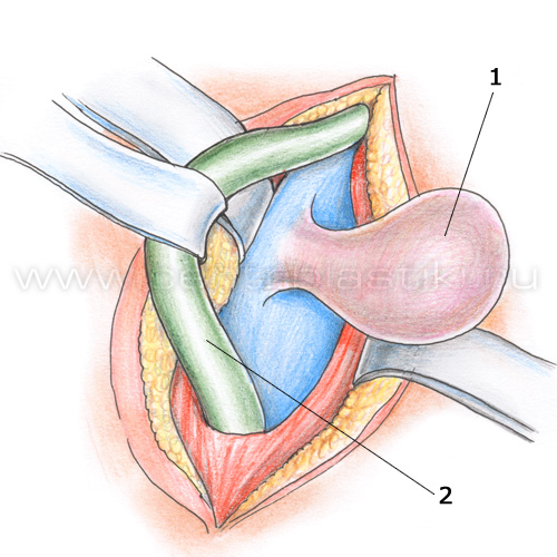 Прямая паховая грыжа