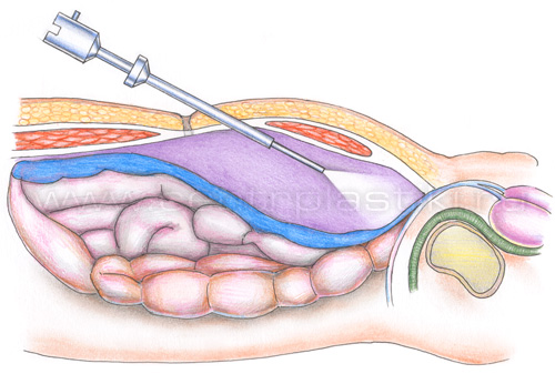 Лапароскопическая герниопластика