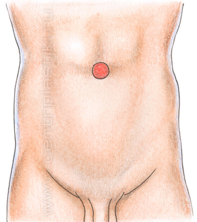 Пупочная грыжа