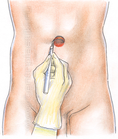 Пупочная грыжа