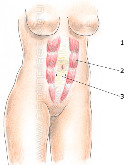 Грыжа белой линии живота