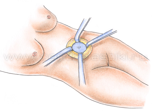 Грыжа белой линии живота