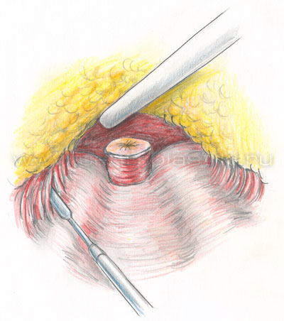Грыжа белой линии живота