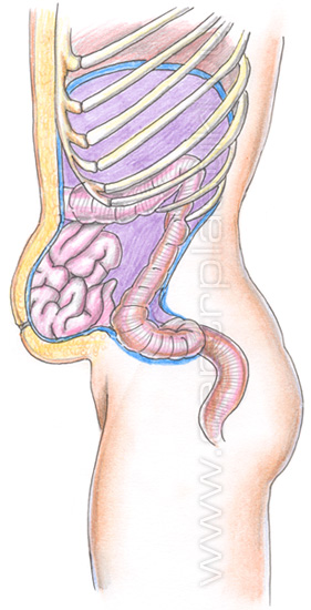 Послеоперационная вентральная грыжа