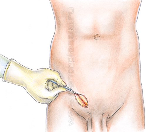 Операция по устранению паховой грыжи