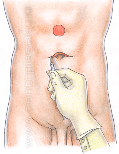 Операция по устранению грыжи белой линии живота
