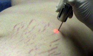 Лазерная шлифовка растяжек