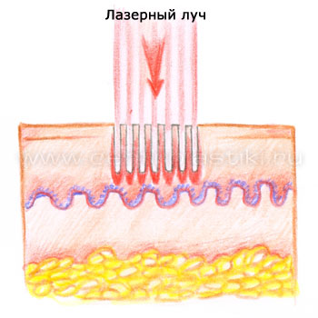 Горячий лазерный пилинг