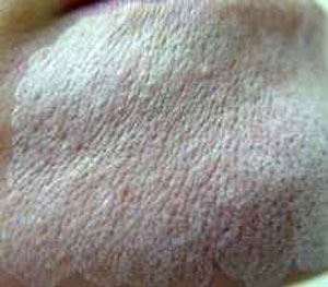 Воздействие лазера на морщины