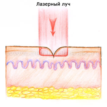Лазерная шлифовка морщин