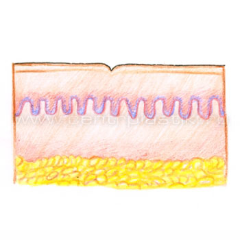 После лазерной шлифовки морщин