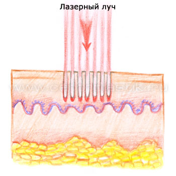 Лазерная абляция