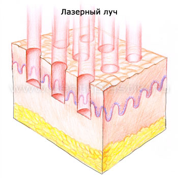 Лазерное омоложение кожи