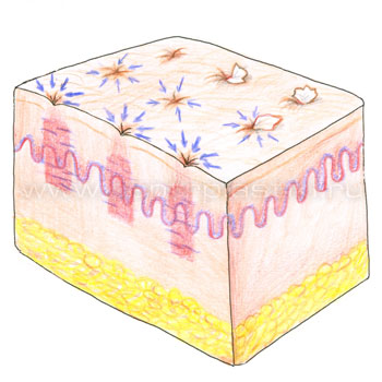 После лазерного омоложения кожи