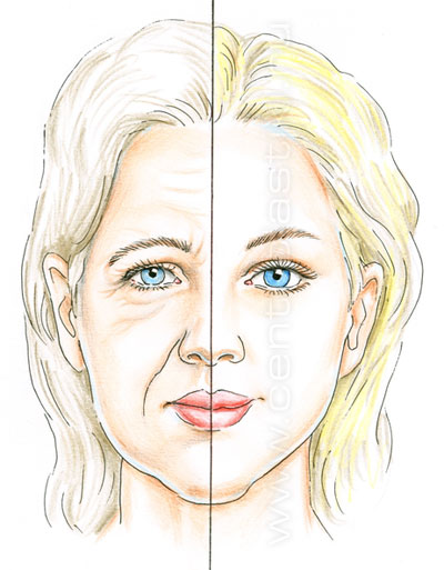 Безоперационная подтяжка лица
