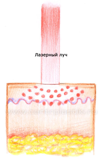 Безоперационная подтяжка лица