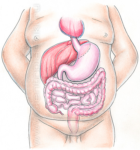 Степени ожирения