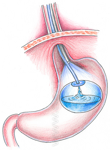 Внутрижелудочный баллон