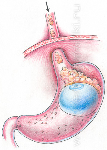 Внутрижелудочный баллон