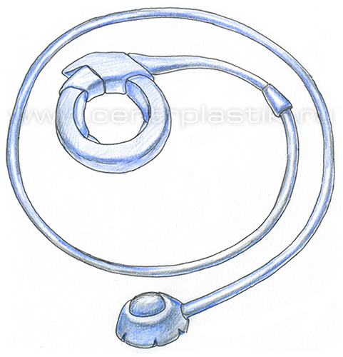 Бандажирование желудка