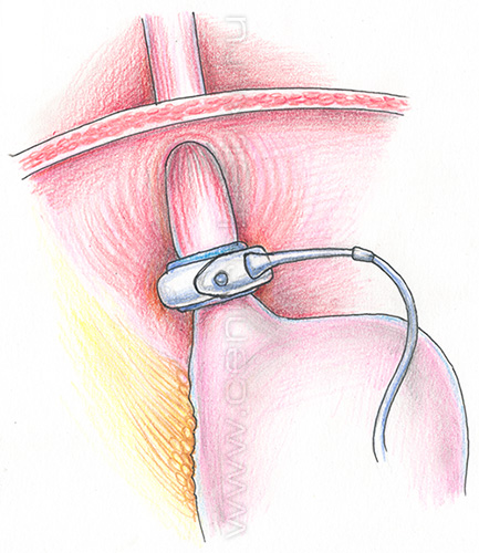 Бандажирование желудка