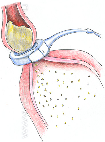 Бандажирование желудка
