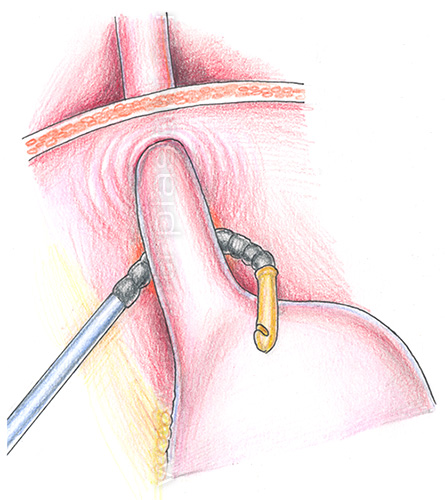 Бандажирование желудка