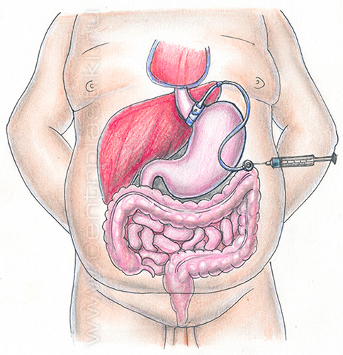 Бандажирование желудка