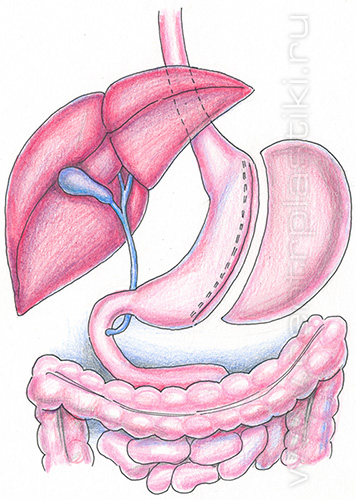 Продольная резекция желудка