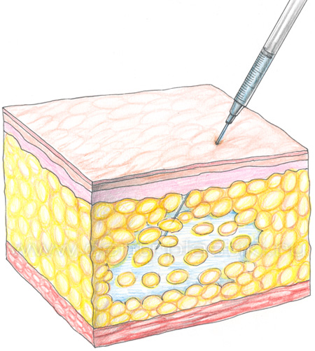 Инъекционный липолиз