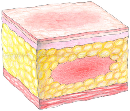 Инъекционный липолиз