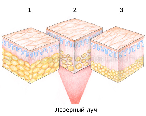 Лазерная липосакция