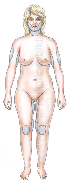 Лазерная липосакция