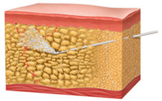 Body-Jet - водоструйная липосакция
