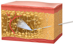 Body-Jet - водоструйная липосакция