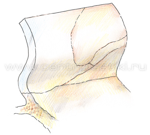 S-образное искривление носовой перегородки