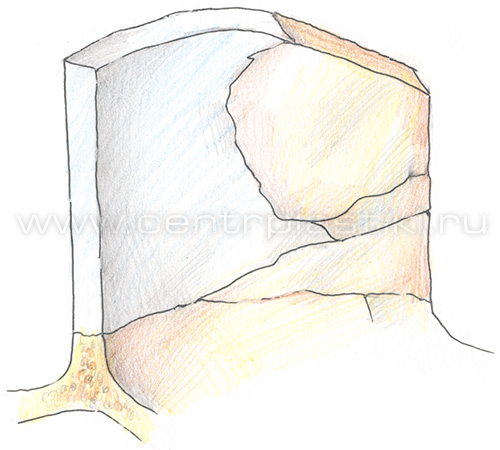 С-образное искривление носовой перегородки