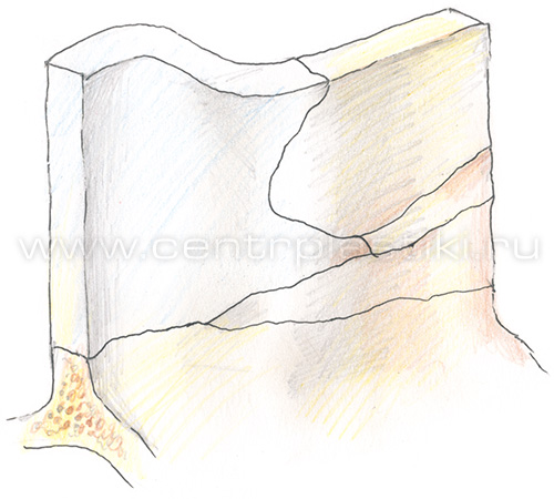 S-образное (передне-заднеее) искривление носовой перегородки