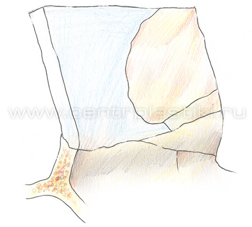 Искривление перегородки носа по отношению к костному гребню верхней челюсти
