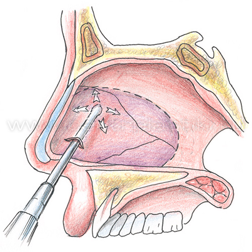 Септопластика - исправление носовой перегородки