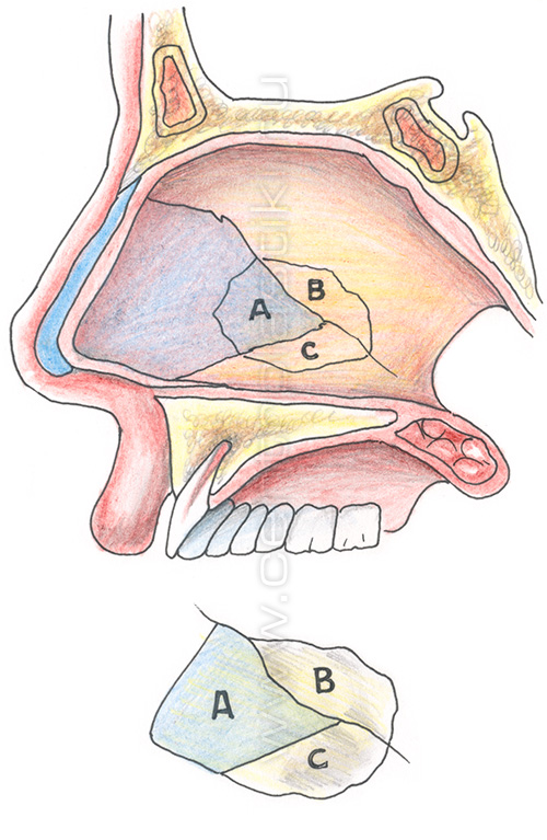 Септопластика - исправление носовой перегородки