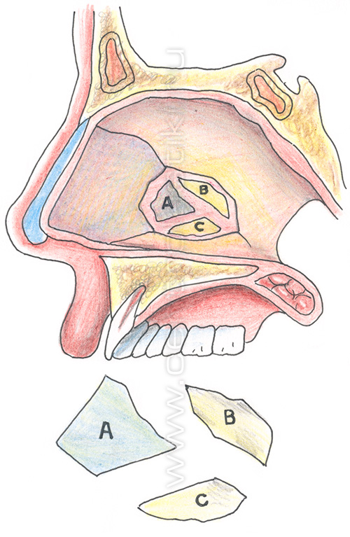 Септопластика - исправление носовой перегородки