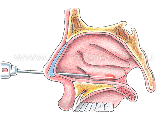 Вазомоторный ринит