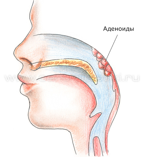 Аденоиды