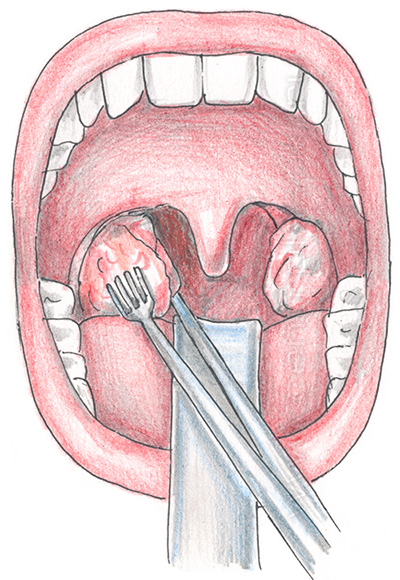 Удаление гланд