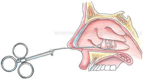 Полипы - удаление