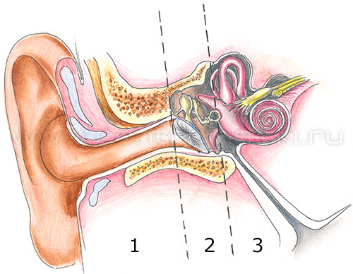 Отосклероз