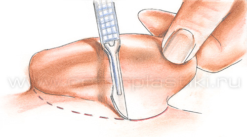 Хронический отит