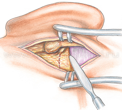 Хронический отит