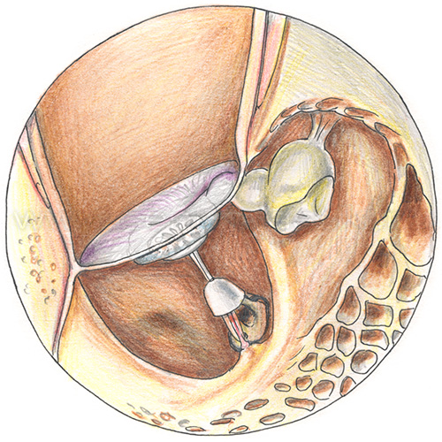 Хронический отит